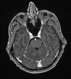 Cerebral toxoplasmosis (Radiopaedia 43956-47461 Axial T1 C+ 21).jpg