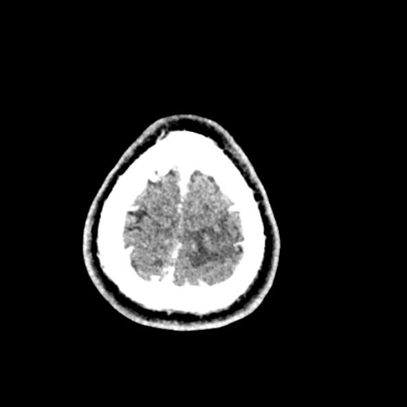 File:Cerebral toxoplasmosis (Radiopaedia 53993-60131 Axial C+ delayed 68).jpg