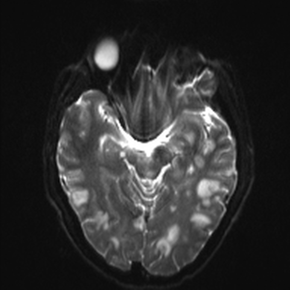 Cerebral toxoplasmosis (Radiopaedia 53993-60132 Axial DWI 11).jpg