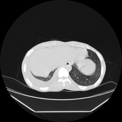 File:Cerebral tuberculoma (Radiopaedia 80829-94318 Axial lung window 159).jpg
