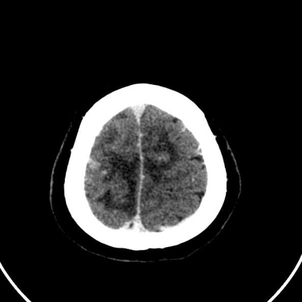 Cerebral venous hemorrhagic infarct from venous sinus thrombosis (Radiopaedia 55433-61883 Axial C+ delayed 22).jpg