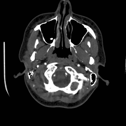 Cerebral venous sinus thrombosis (Radiopaedia 40619-43227 A 21).jpg