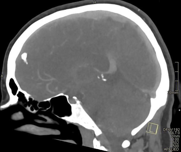 Cerebral venous sinus thrombosis (Radiopaedia 91329-108965 Sagittal venogram 37).jpg