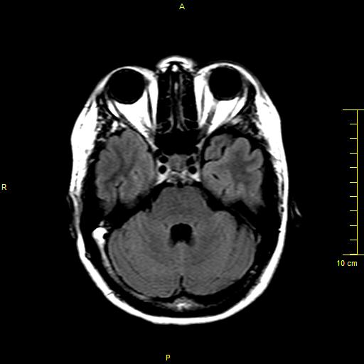 File:Cerebral venous thrombosis (Radiopaedia 23288-23351 Axial FLAIR 4).JPG
