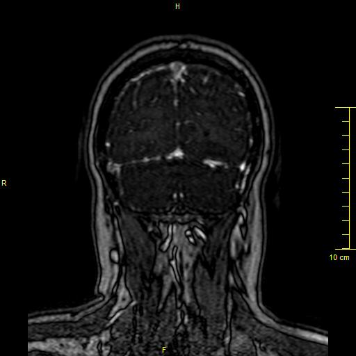 Cerebral venous thrombosis (Radiopaedia 23288-23351 MRV 149).JPG