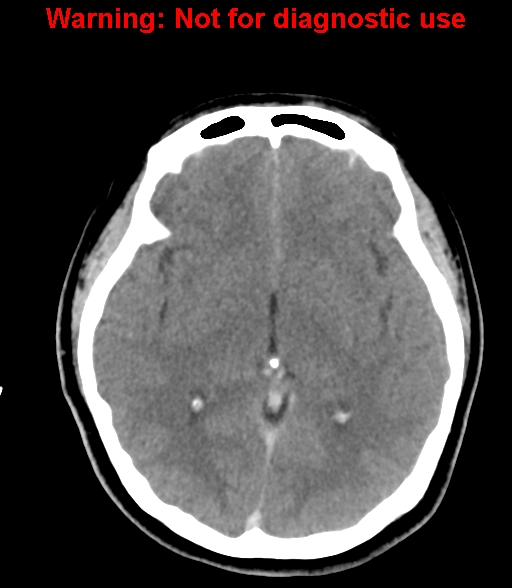 File:Cerebral venous thrombosis (Radiopaedia 37224-38992 Axial non-contrast 14).jpg