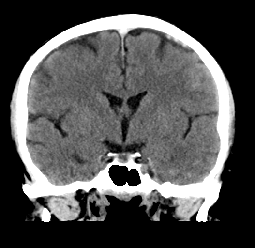 File:Cerebral venous thrombosis (Radiopaedia 38392-40467 Coronal non-contrast 18).png