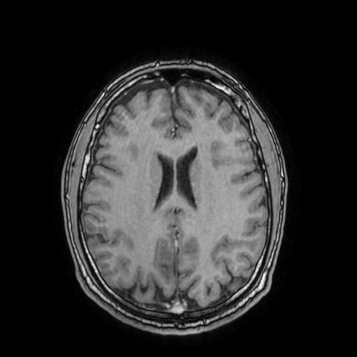 Cerebral venous thrombosis with secondary intracranial hypertension (Radiopaedia 89842-106957 Axial T1 C+ 114).jpg