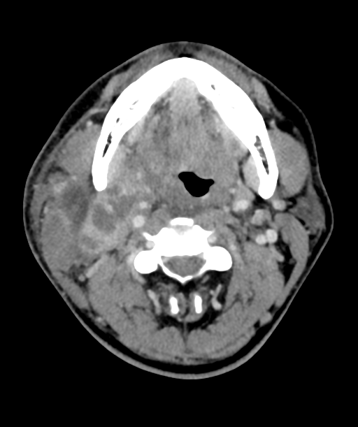 Cervical abscess (Radiopaedia 43725-47184 A 26).png