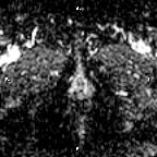 File:Cervical adenocarcinoma (Radiopaedia 65011-73985 Axial ADC 2).jpg