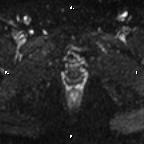 Cervical adenocarcinoma (Radiopaedia 65011-73985 Axial DWI 19).jpg