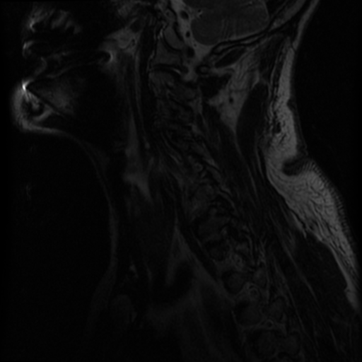 File:Cervical canal stenosis with cord compression (Radiopaedia 34114-35374 Sagittal T2 11).png
