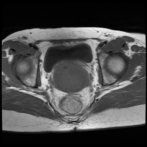 File:Cervical cancer (Radiopaedia 62991-71413 Axial T1 12).jpg