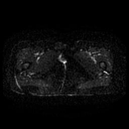 File:Cervical carcinoma (Radiopaedia 67644-77047 Axial DWI 48).jpg