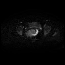 Cervical carcinoma (Radiopaedia 88010-104555 Axial DWI 29).jpg