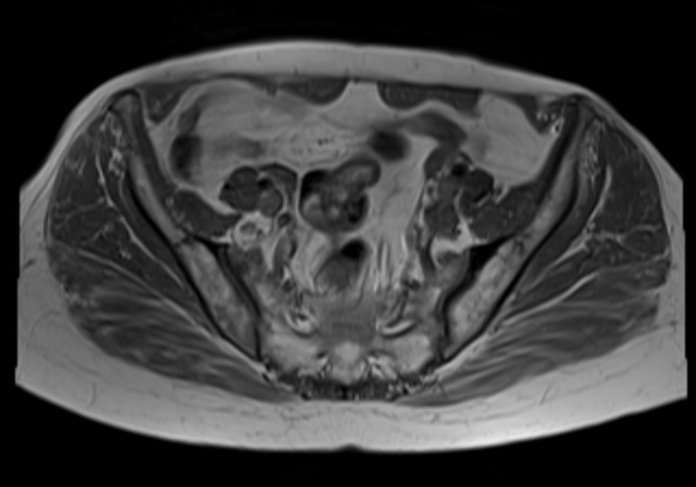 File:Cervical carcinoma (Radiopaedia 88312-104943 Axial T1 8).jpg