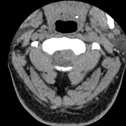 Cervical spinal neurofibroma in a patient with NF1 (Radiopaedia 58344-65464 Axial non-contrast 19).jpg