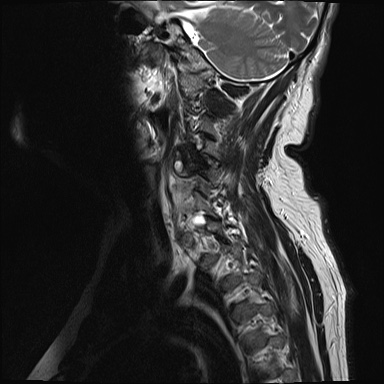 File:Cervical spinal neurofibroma in a patient with NF1 (Radiopaedia 58344-65465 Sagittal T2 11).jpg