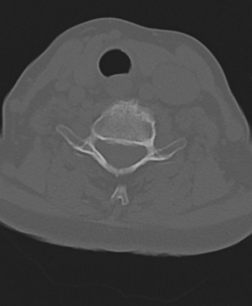 Cervical spine ACDF loosening (Radiopaedia 48998-54071 Axial bone window 42).png