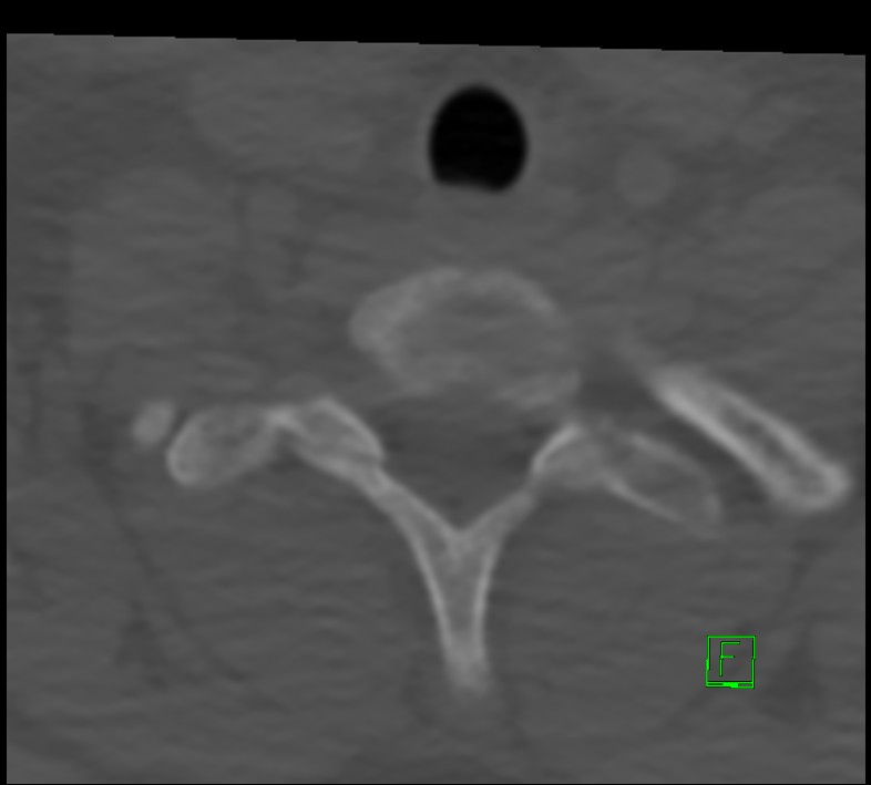 Cervical spine fracture - hyperflexion injury (Radiopaedia 66184-75364 Axial bone window 51).jpg