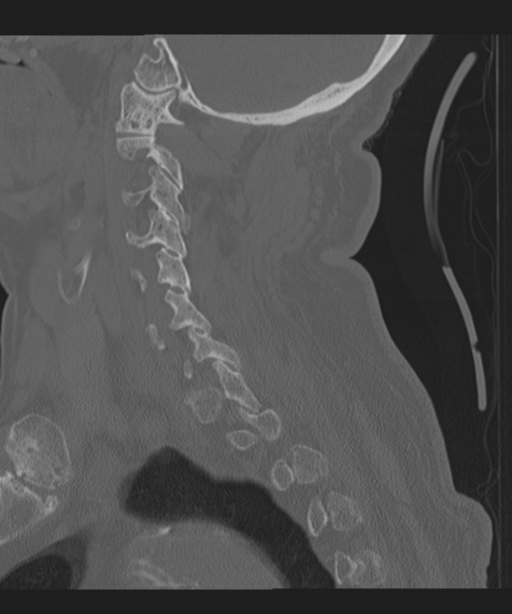 Cervical spine fracture in the setting of ankylosis (Radiopaedia 37038-38715 Sagittal bone window 27).png