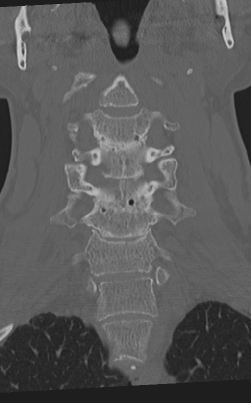 Cervical spine fractures with vertebral artery dissection (Radiopaedia 53296-59268 Coronal bone window 26).png