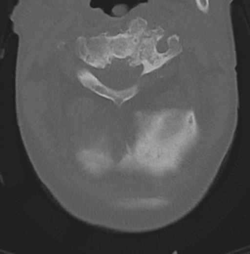 Cervical spondylolysis (Radiopaedia 49616-54811 Axial bone window 14).png