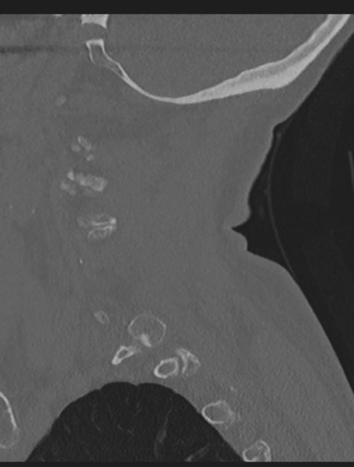 Cervical spondylolysis (Radiopaedia 49616-54811 Sagittal bone window 16).png