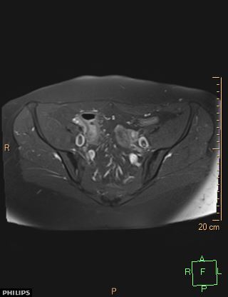 File:Cesarian scar endometriosis (Radiopaedia 68495-78066 Axial T1 C+ fat sat 7).jpg