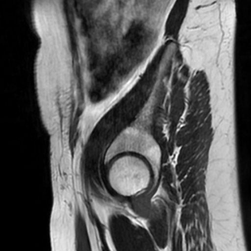 File:Cesarian section scar endometriosis (Radiopaedia 66520-75799 Sagittal T2 17).jpg