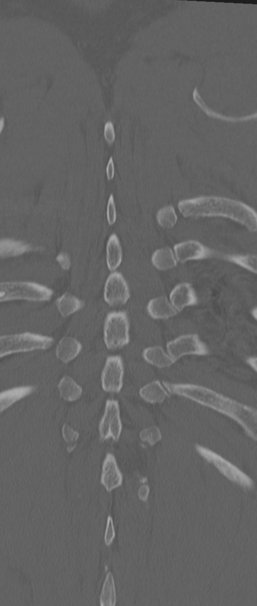 Chance fracture (Radiopaedia 33854-35020 Coronal bone window 74).png