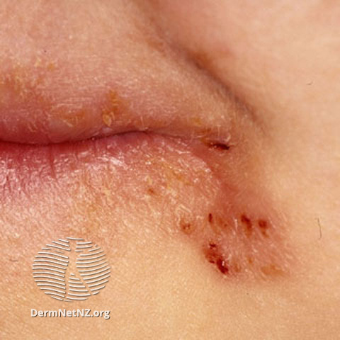 File:Cheilitis (DermNet NZ dermatitis-s-atopic28).jpg