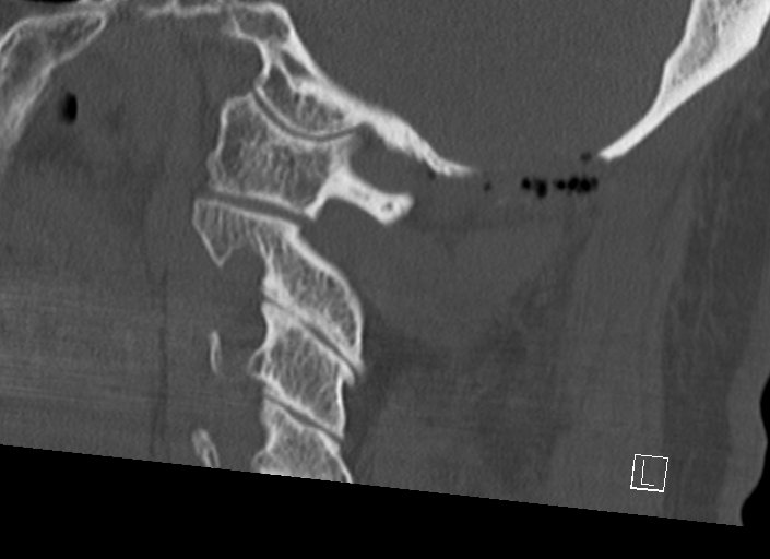Chiari I malformation with a symptomatic syrinx of the posterolateral medulla oblongata (Radiopaedia 42573-45707 A 39).jpg