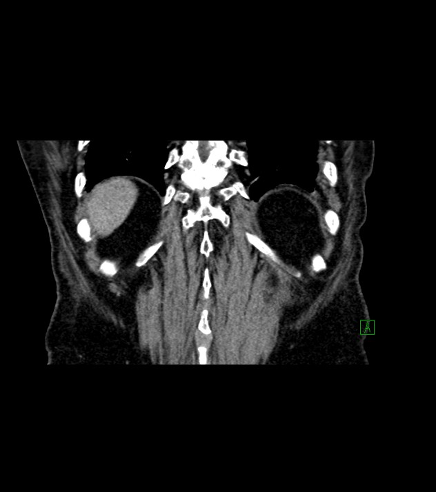 Cholangiocarcinoma with cerebral metastases (Radiopaedia 83519-98629 Coronal C+ delayed 71).jpg