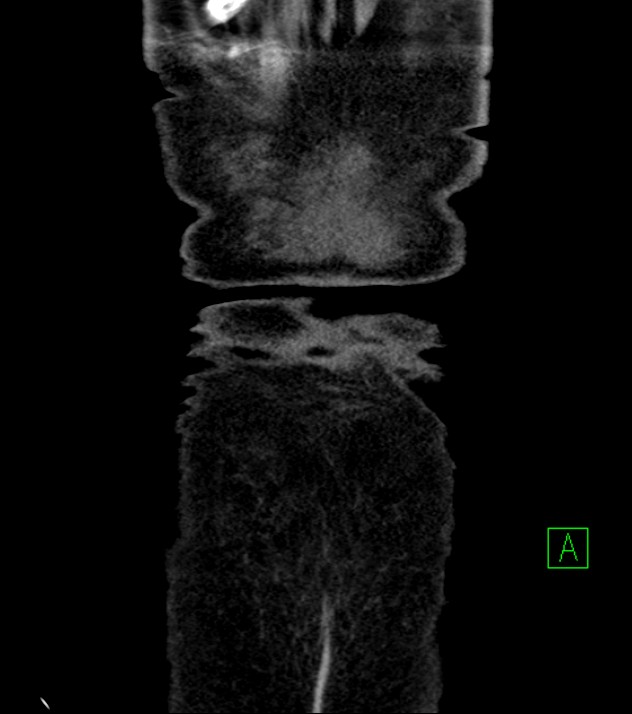 Cholangiocarcinoma with cerebral metastases (Radiopaedia 83519-98629 E 87).jpg