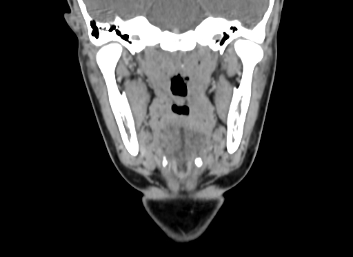 Chondroblastic osteosarcoma (Radiopaedia 67363-76741 D 61).jpg