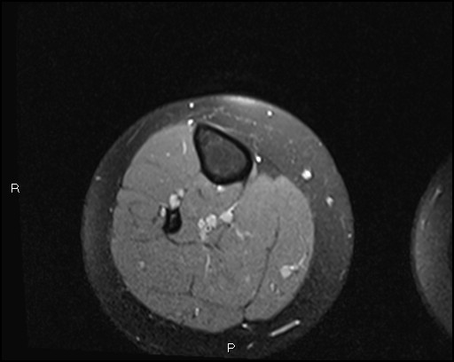 File:Chondroblastoma (Radiopaedia 62721-71031 Axial PD fat sat 39).jpg