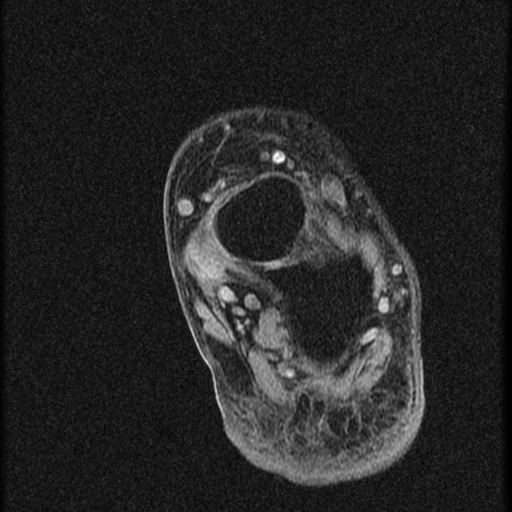 File:Chondroblastoma - midfoot (Radiopaedia 64831-73765 F 6).jpg