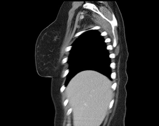 Chondrosarcoma - chest wall (Radiopaedia 65192-74199 B 51).jpg