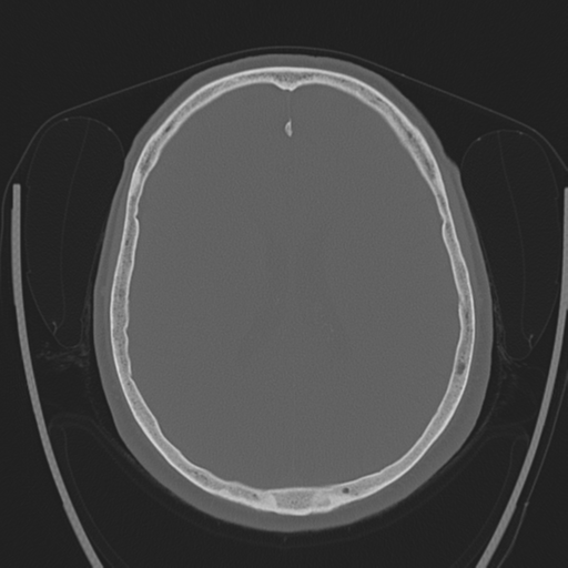 File:Chondrosarcoma of skull base- grade II (Radiopaedia 40948-43653 Axial bone window 30).png
