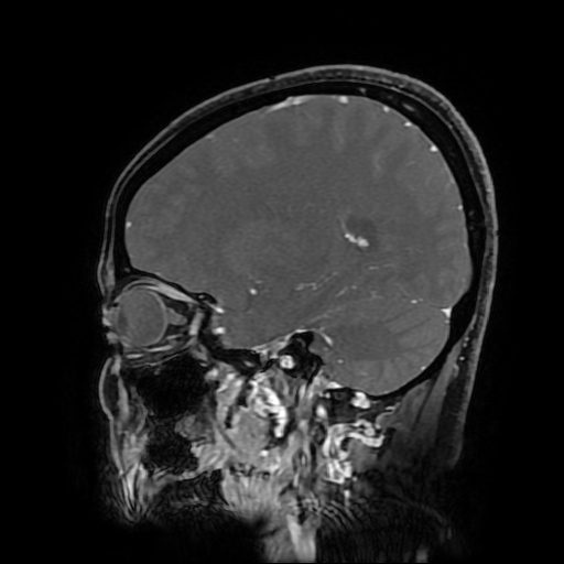 File:Chordoid glioma of third ventricle (Radiopaedia 91612-109340 F 138).jpg