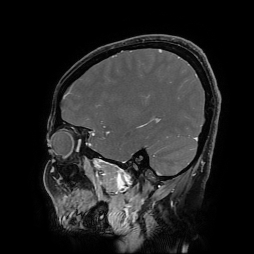 Chordoid glioma of third ventricle (Radiopaedia 91612-109340 F 150).jpg