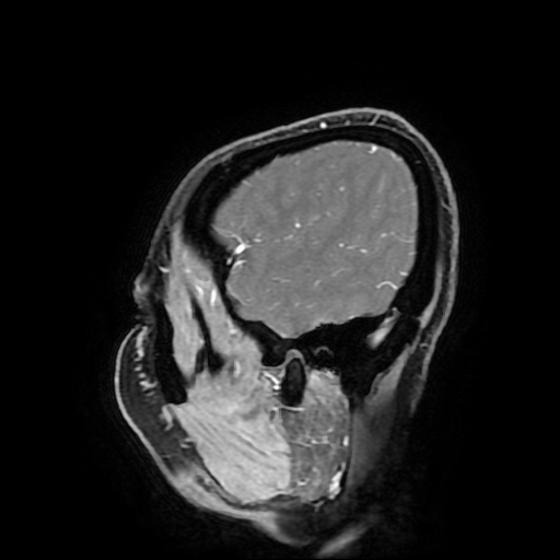 Chordoid glioma of third ventricle (Radiopaedia 91612-109340 F 39).jpg
