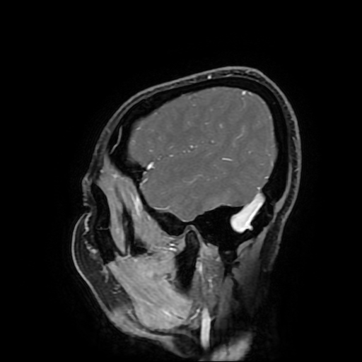 Chordoid glioma of third ventricle (Radiopaedia 91612-109340 F 43).jpg