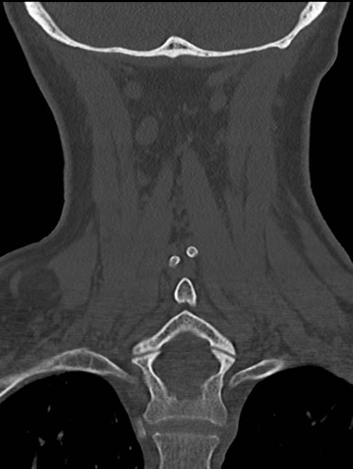 Chordoma (C4 vertebra) (Radiopaedia 47561-52188 Coronal bone window 45).png