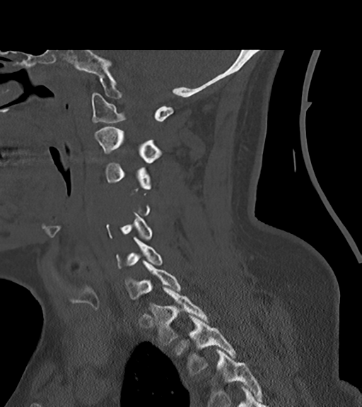 File:Chordoma (C4 vertebra) (Radiopaedia 47561-52188 Sagittal bone window 48).png