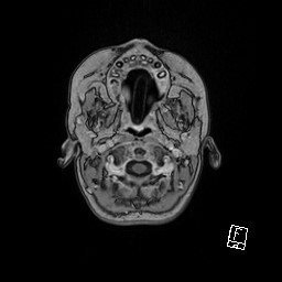 Choroid plexus papilloma (Radiopaedia 92022-109829 Axial T1 C+ 2).jpg