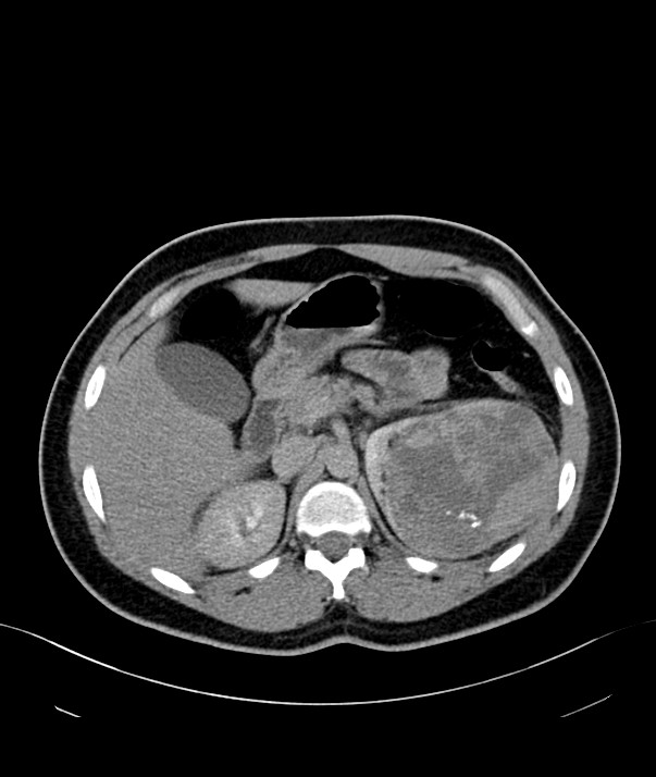 Chromophobe renal cell carcinoma (Radiopaedia 84255-99542 H 9).jpg