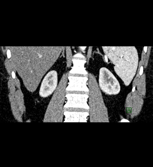 Chromophobe renal cell carcinoma (Radiopaedia 84286-99573 E 65).jpg