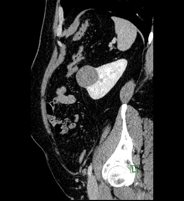 Chromophobe renal cell carcinoma (Radiopaedia 84286-99573 I 42).jpg